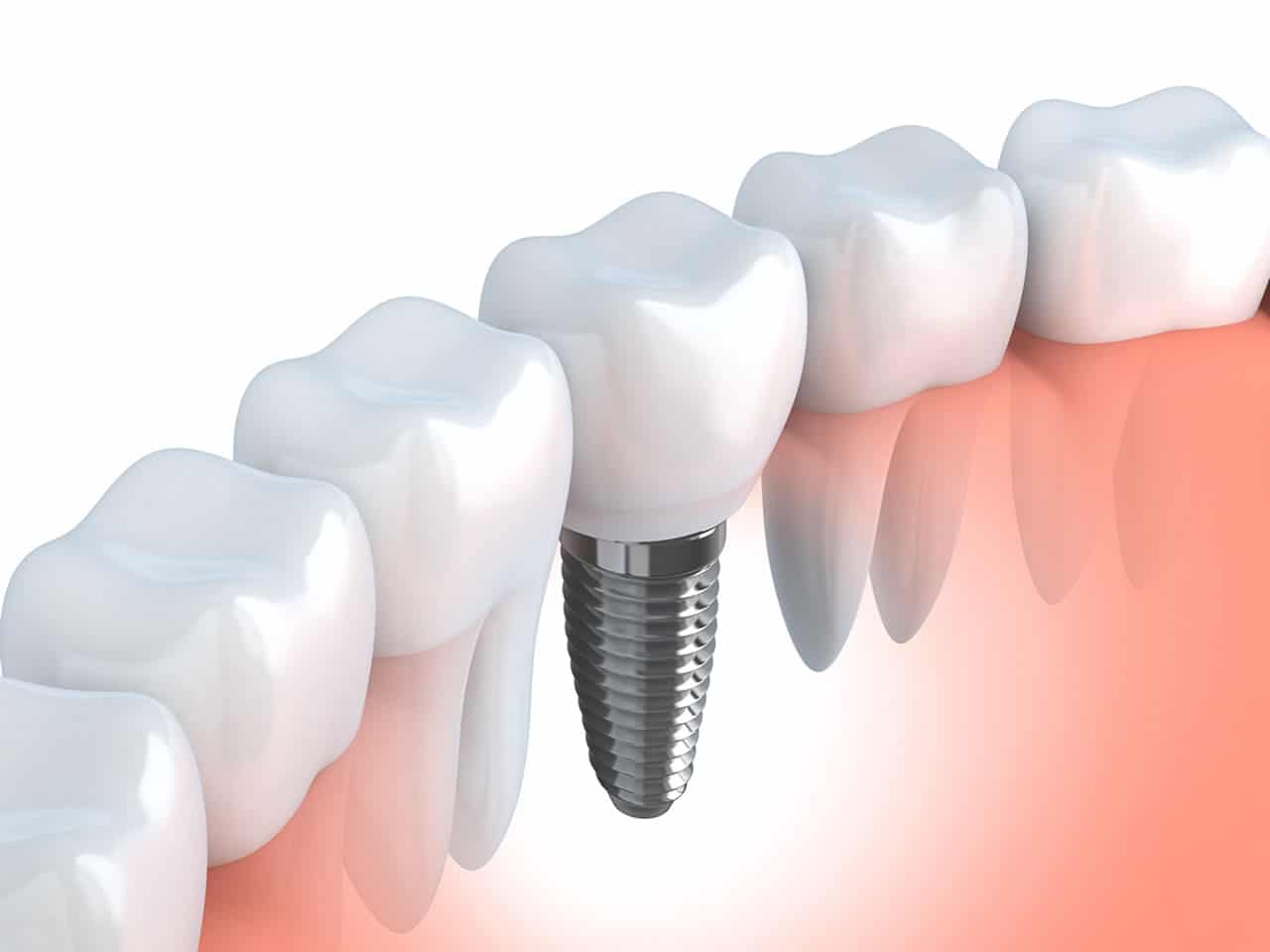 Dental Implants Brunswick, ME