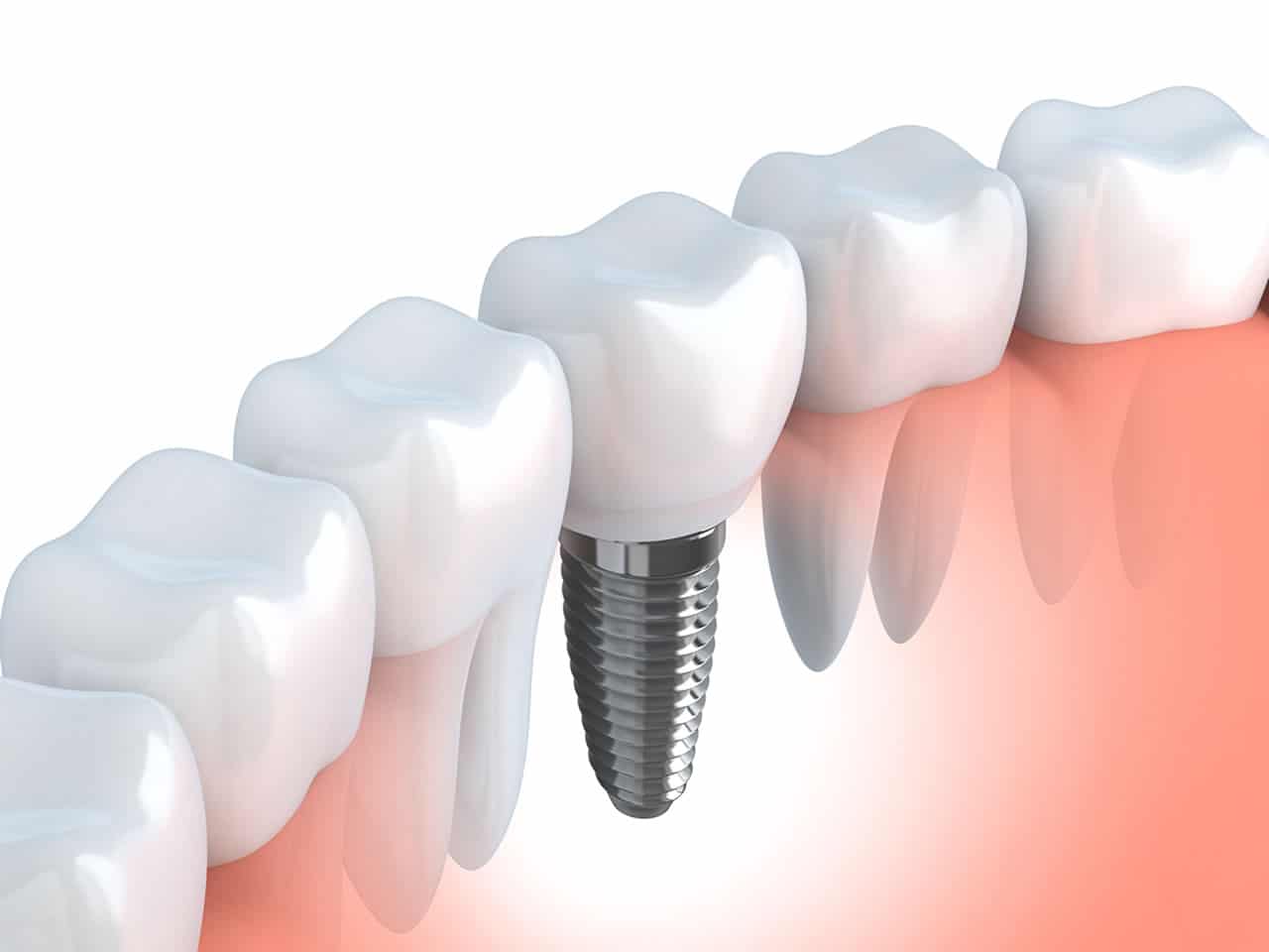 Dental Implants Brunswick ME