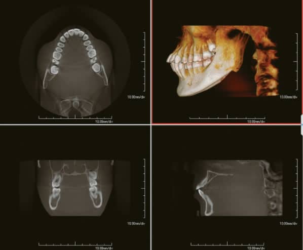 Computer Tomography Dental Implant Example