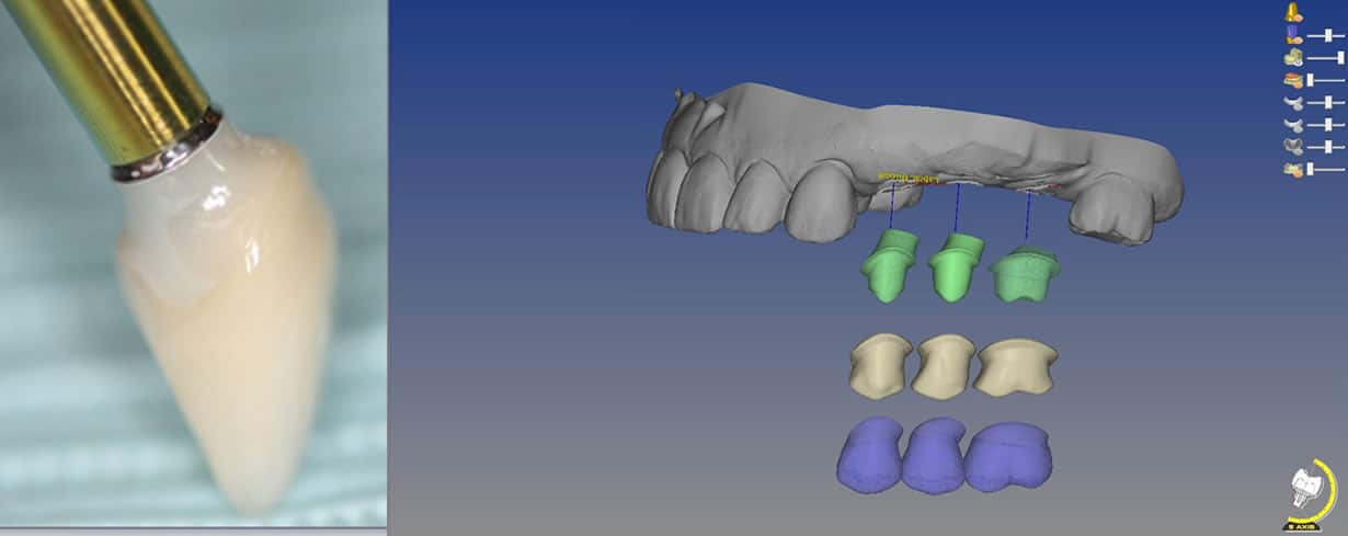 Cad-Cam Milled Restorations