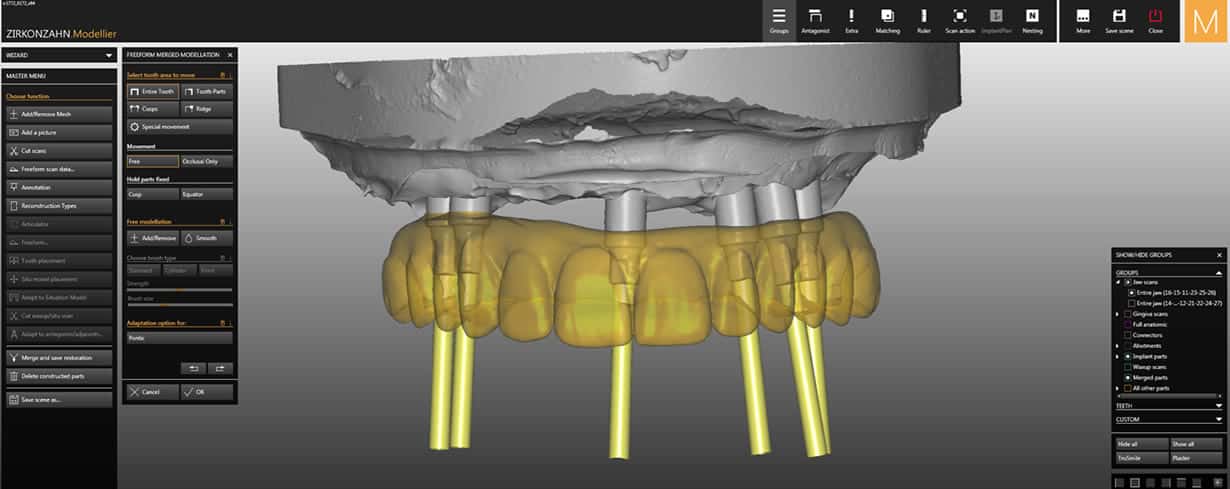 Provisional TeethXpress Teeth Brunswick ME