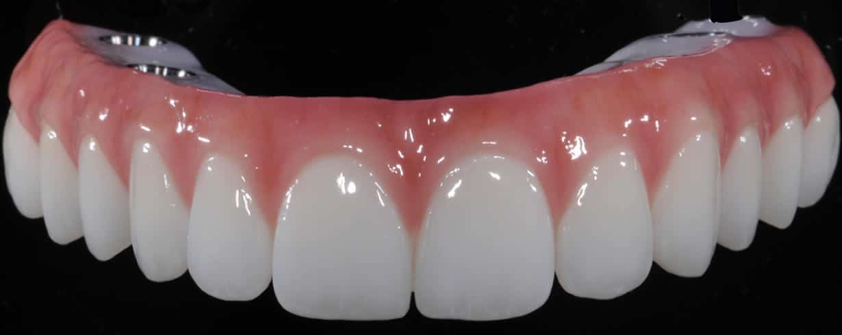 Final Full-Arch TeethXpress Teeth Brunswick ME