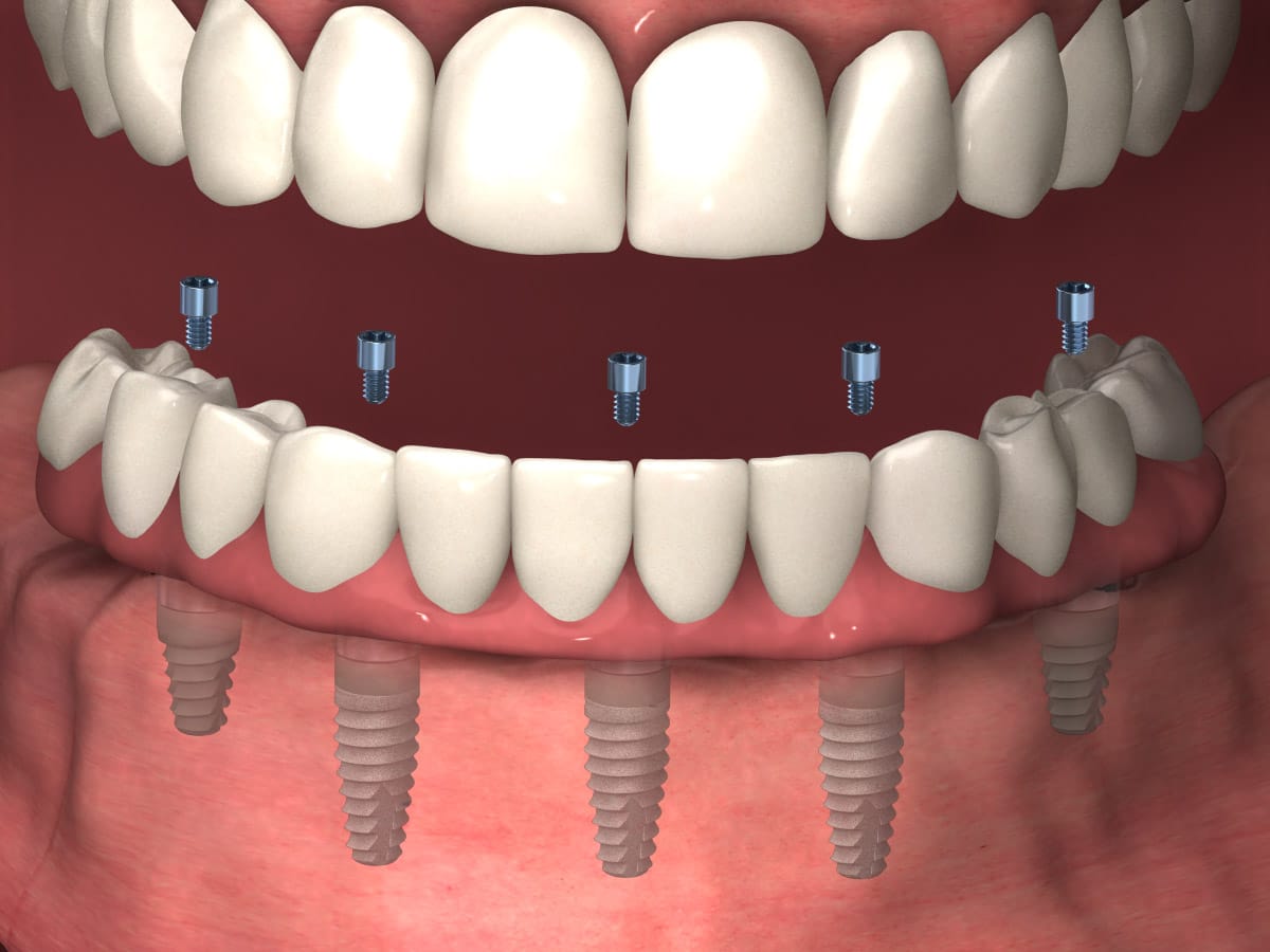 TeethXpress® Dental Implants Maine