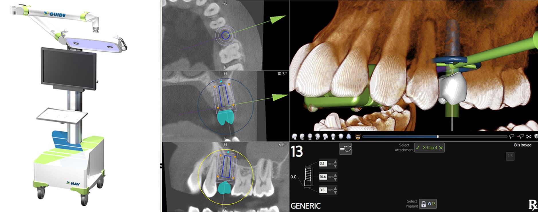 Dental Implant in progress Example