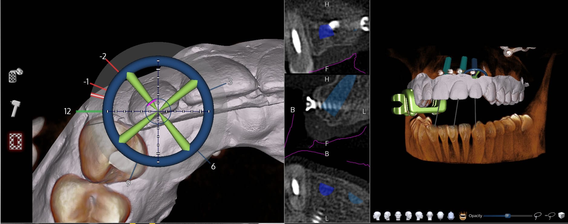 Computer generated tooth implant