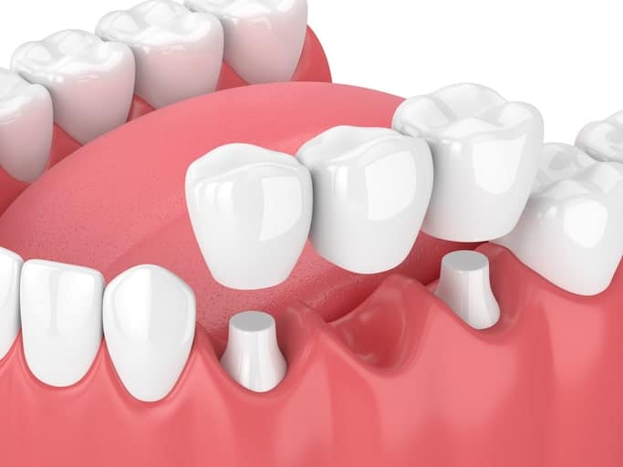 3-D Computer Generated Diagram of Dental Bridge being inserted into gums against white background