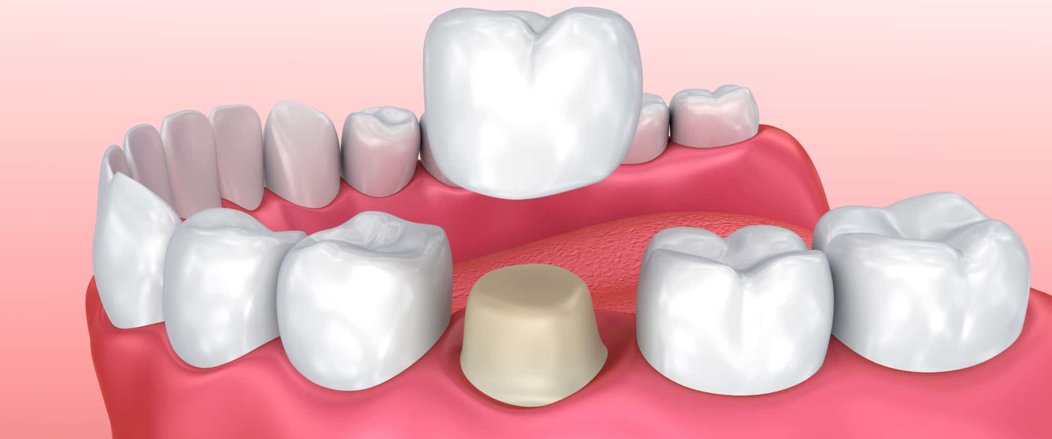 Dental Crown Brunswick ME