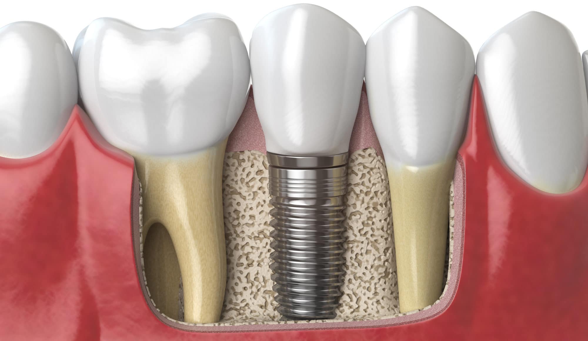 Dental Implants | Dr. Oshetski