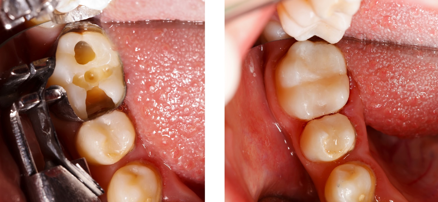 Before And After image of Tooth-Colored Filling Brunswick ME